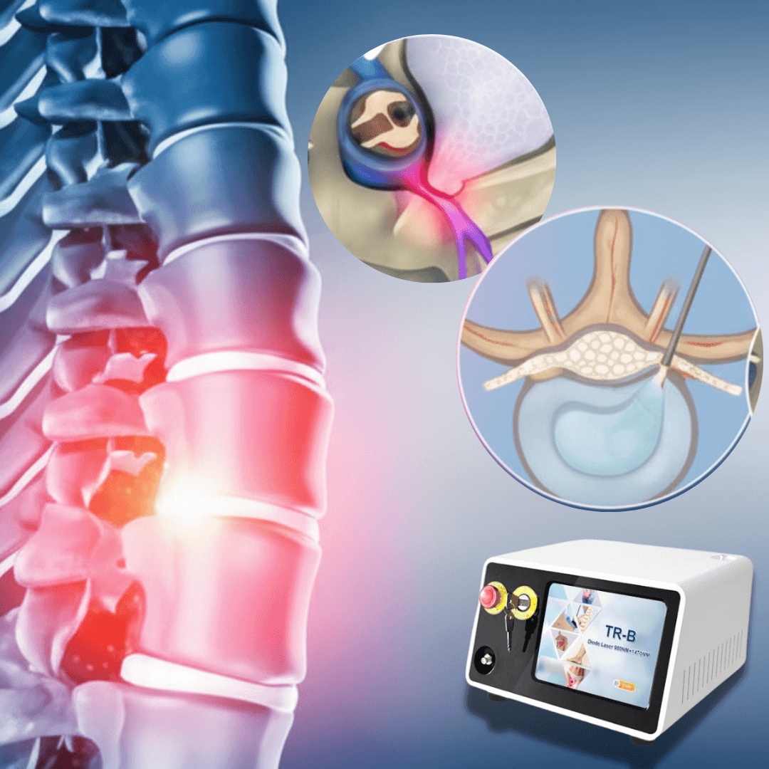 Diagram showing Percutaneous Laser Disc Decompression.